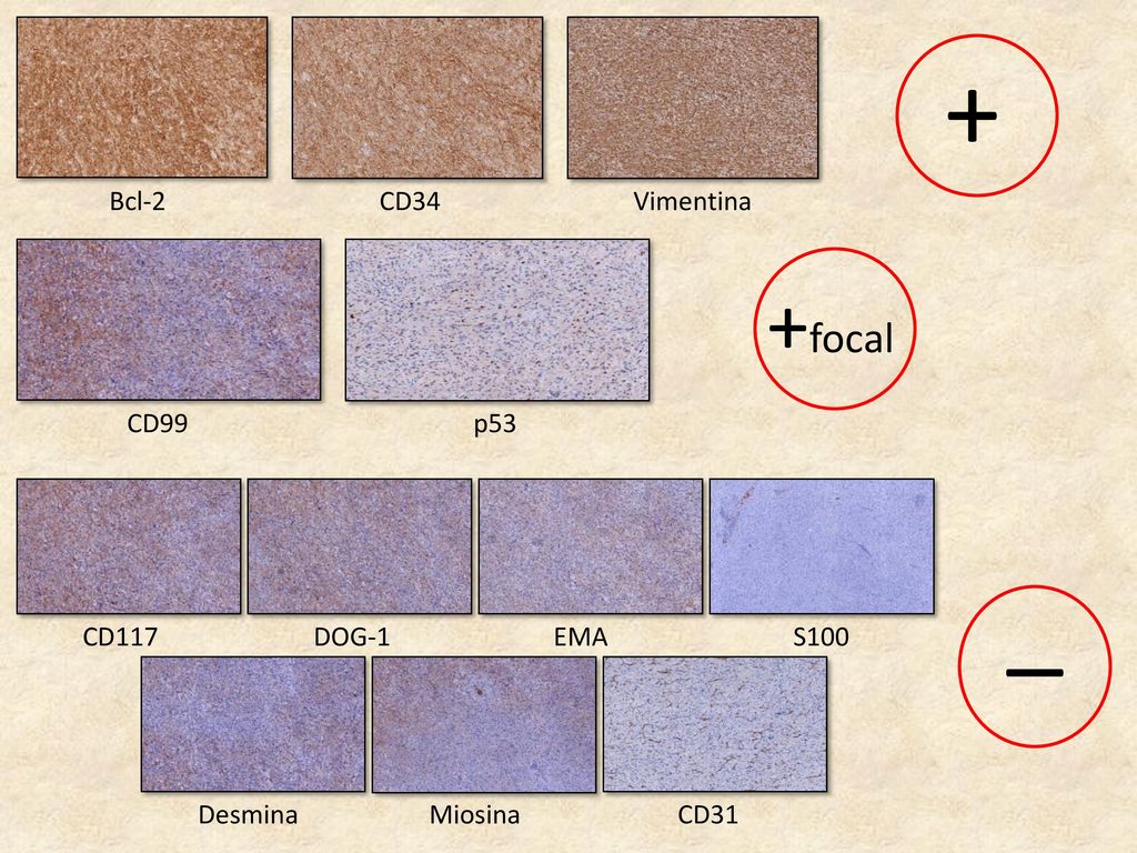 + _ +focal Bcl-2 CD34 Vimentina CD99 p53 CD117 DOG-1 EMA S100 Desmina