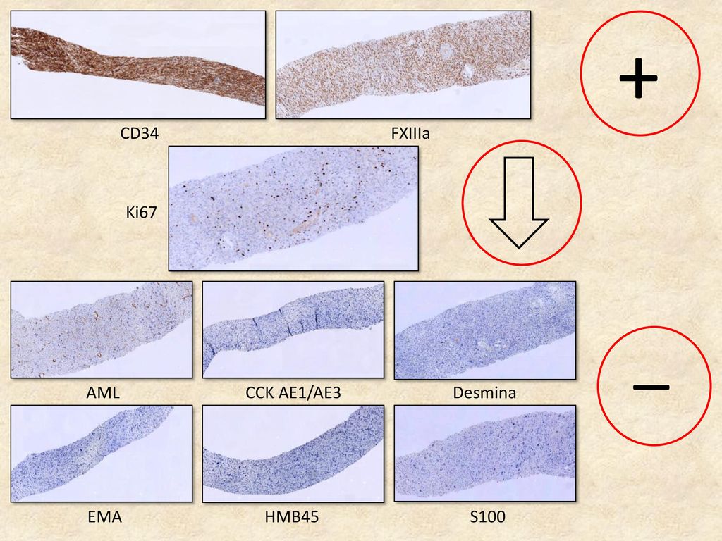 + CD34 FXIIIa Ki67 _ AML CCK AE1/AE3 Desmina EMA HMB45 S100