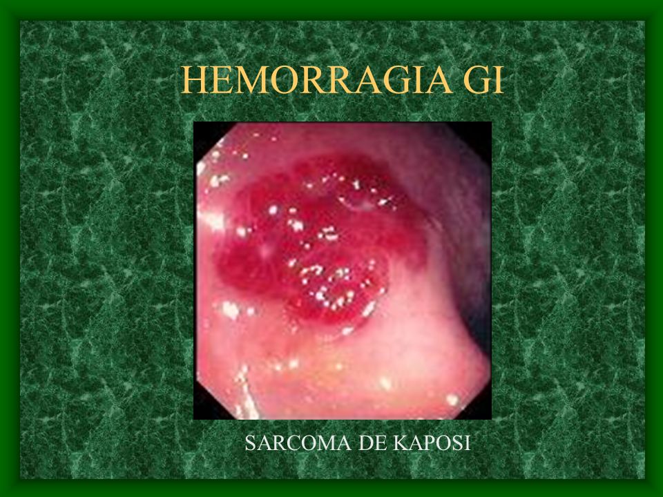 HEMORRAGIA GI SARCOMA DE KAPOSI