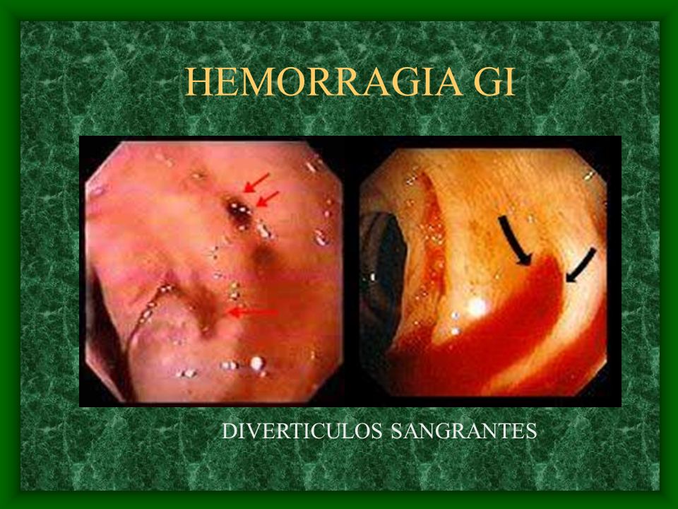 HEMORRAGIA GI DIVERTICULOS SANGRANTES