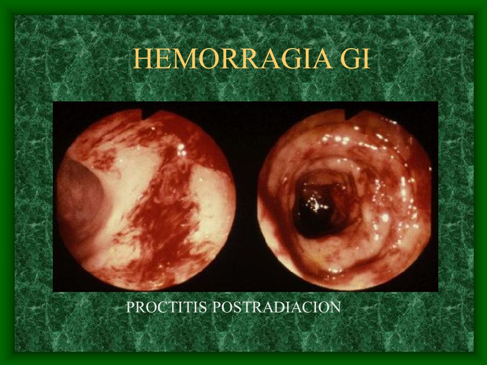 HEMORRAGIA GI PROCTITIS POSTRADIACION