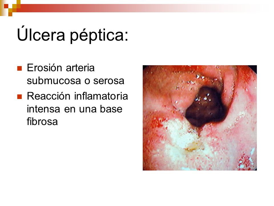 Úlcera péptica: Erosión arteria submucosa o serosa