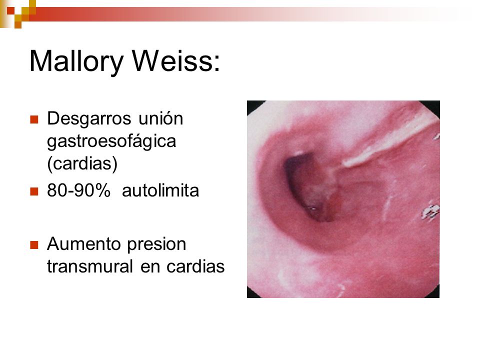 Mallory Weiss: Desgarros unión gastroesofágica (cardias)