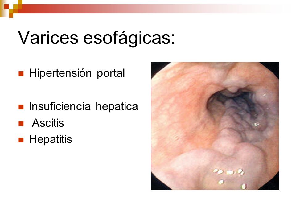 Varices esofágicas: Hipertensión portal Insuficiencia hepatica Ascitis