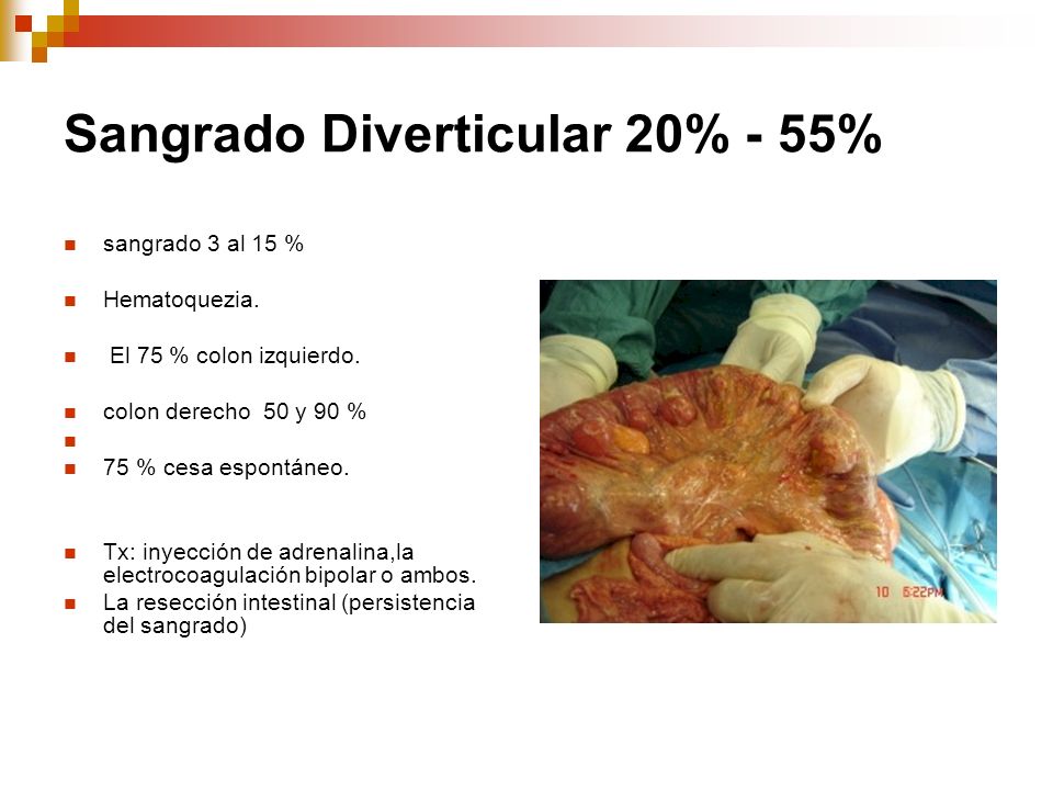 Sangrado Diverticular 20% - 55%