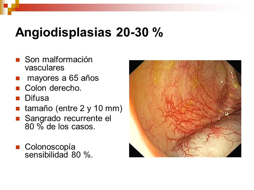 Angiodisplasias % Son malformación vasculares mayores a 65 años