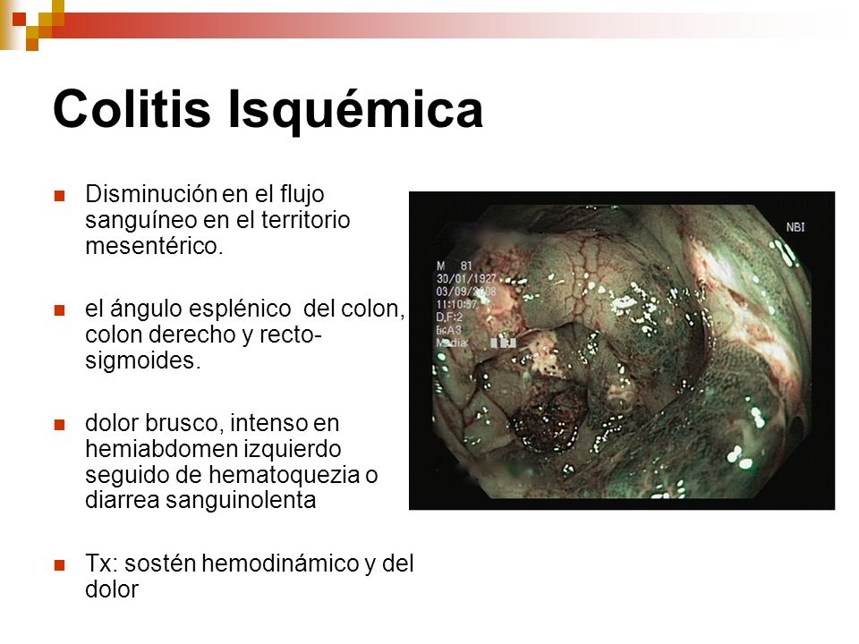 Colitis Isquémica Disminución en el flujo sanguíneo en el territorio mesentérico. el ángulo esplénico del colon, colon derecho y recto-sigmoides.