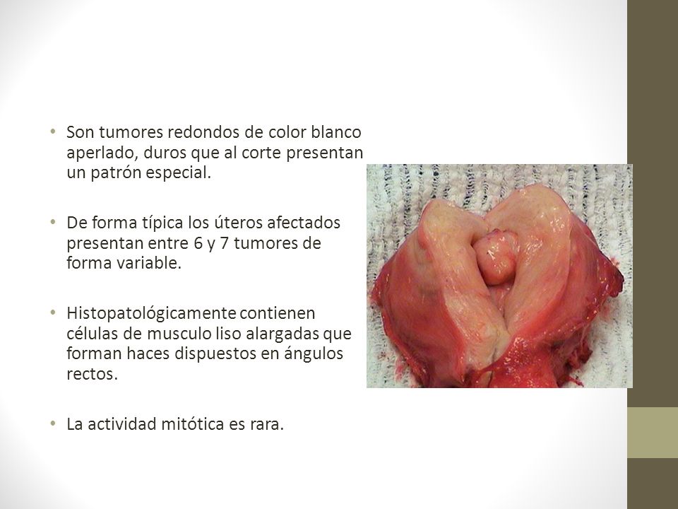 Son tumores redondos de color blanco aperlado, duros que al corte presentan un patrón especial.