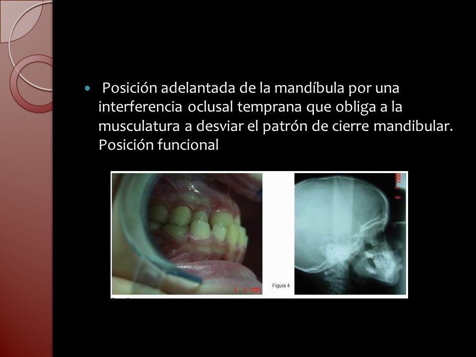 Posición adelantada de la mandíbula por una interferencia oclusal temprana que obliga a la musculatura a desviar el patrón de cierre mandibular.