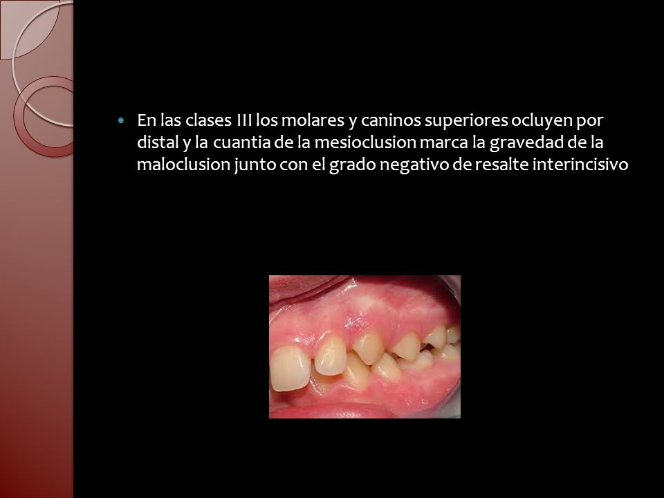 En las clases III los molares y caninos superiores ocluyen por distal y la cuantia de la mesioclusion marca la gravedad de la maloclusion junto con el grado negativo de resalte interincisivo