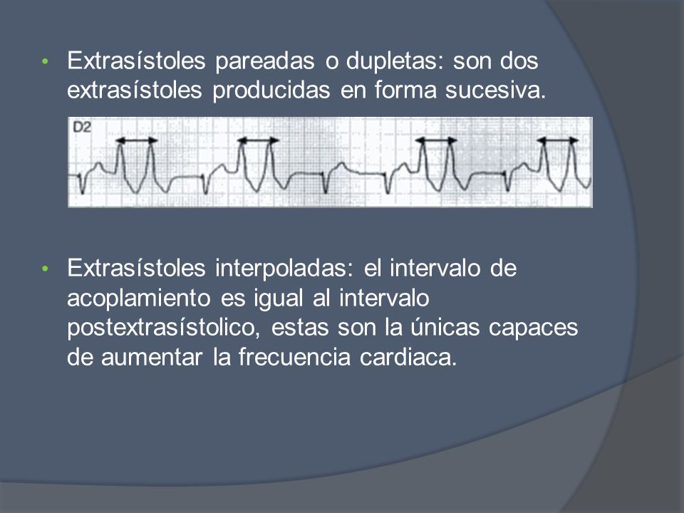 Extrasístoles pareadas o dupletas: son dos extrasístoles producidas en forma sucesiva.