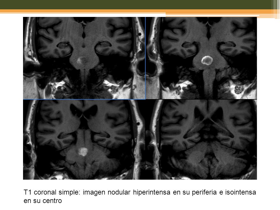 T1 coronal simple: imagen nodular hiperintensa en su periferia e isointensa en su centro