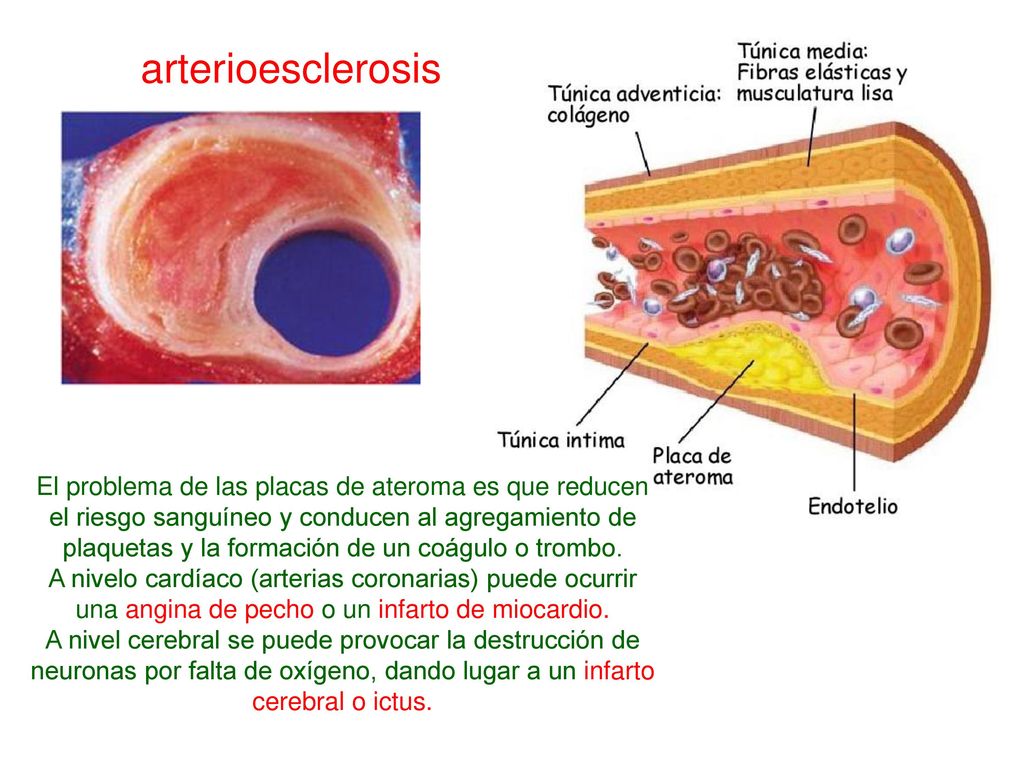 arterioesclerosis