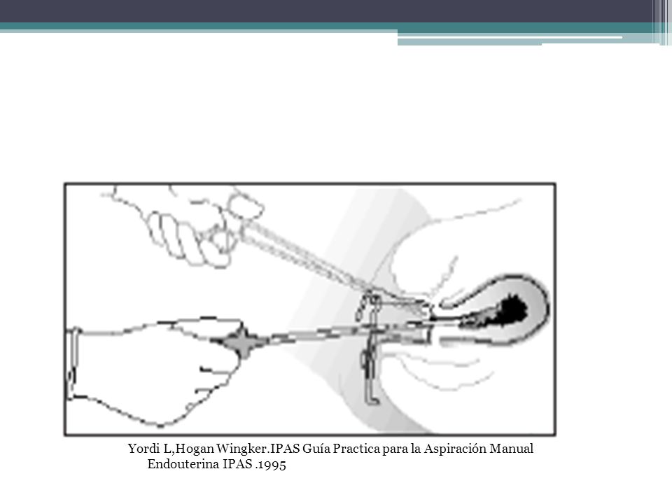 Yordi L,Hogan Wingker.IPAS Guía Practica para la Aspiración Manual Endouterina IPAS .1995
