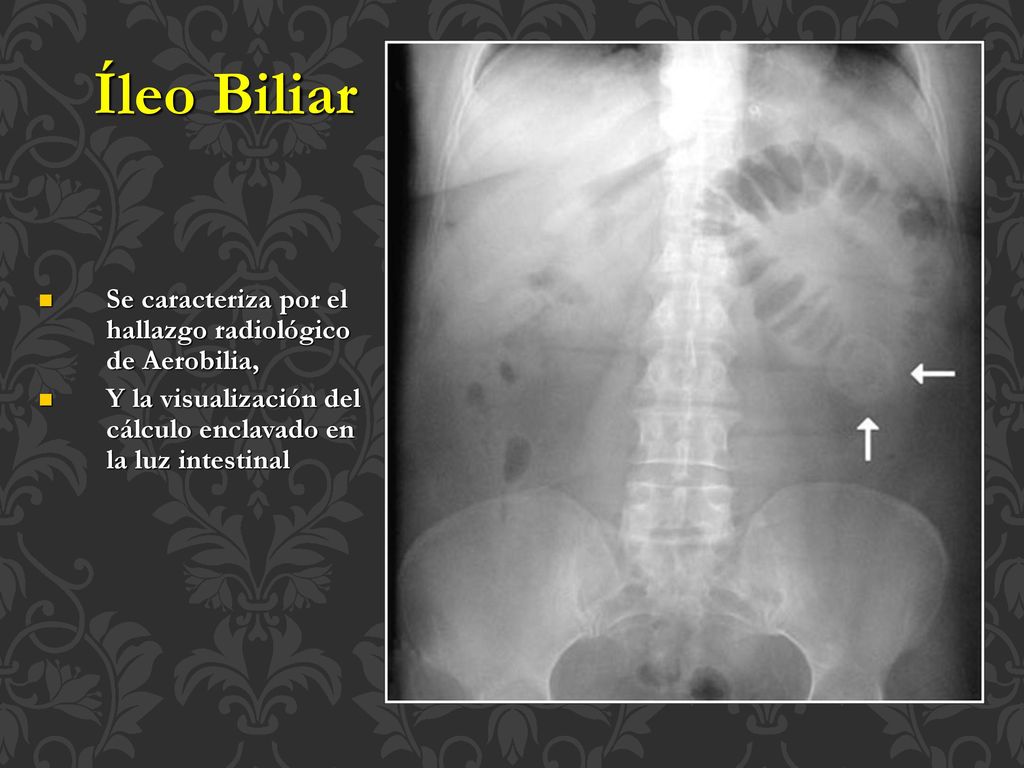 Íleo Biliar Se caracteriza por el hallazgo radiológico de Aerobilia,