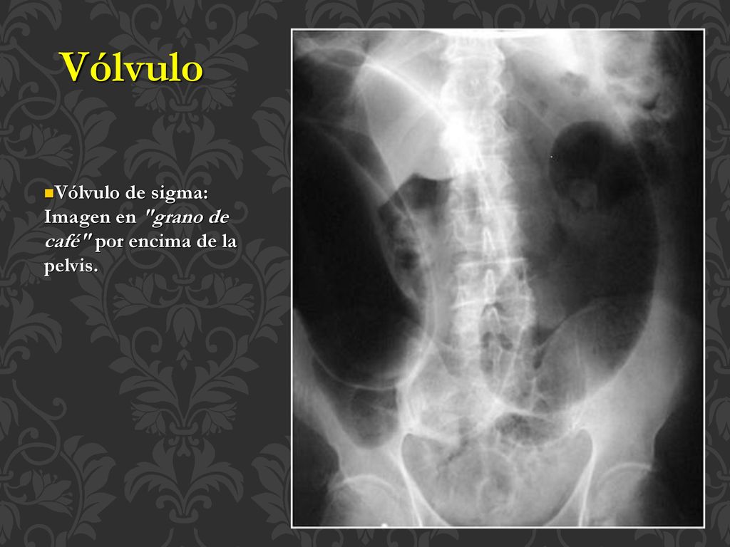 Vólvulo Vólvulo de sigma: Imagen en grano de café por encima de la pelvis.