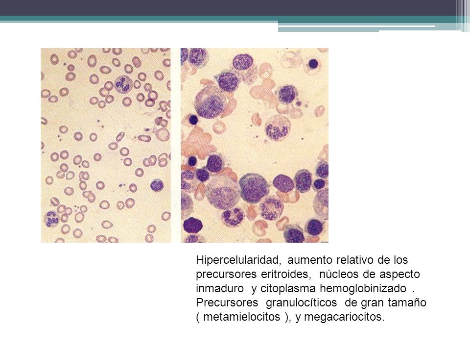 Hipercelularidad, aumento relativo de los precursores eritroides, núcleos de aspecto inmaduro y citoplasma hemoglobinizado .