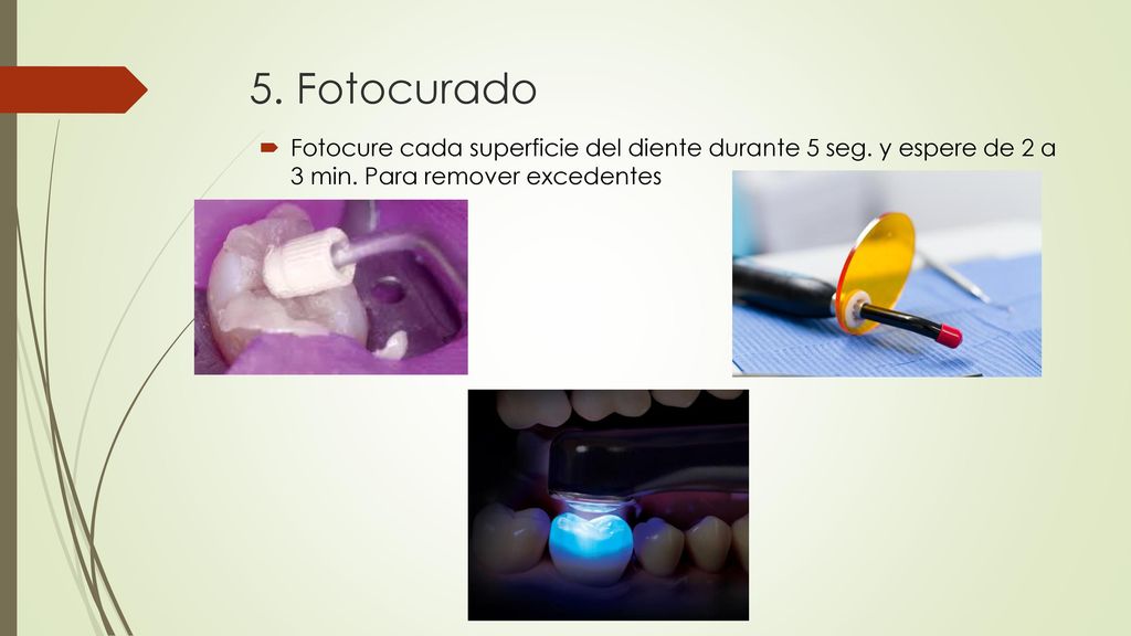 5. Fotocurado Fotocure cada superficie del diente durante 5 seg.