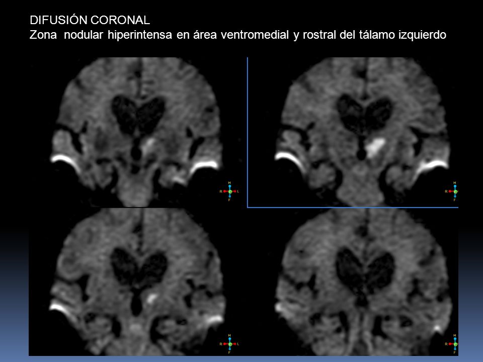 DIFUSIÓN CORONAL Zona nodular hiperintensa en área ventromedial y rostral del tálamo izquierdo