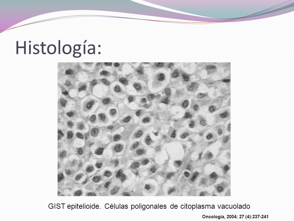 GIST epitelioide. Células poligonales de citoplasma vacuolado