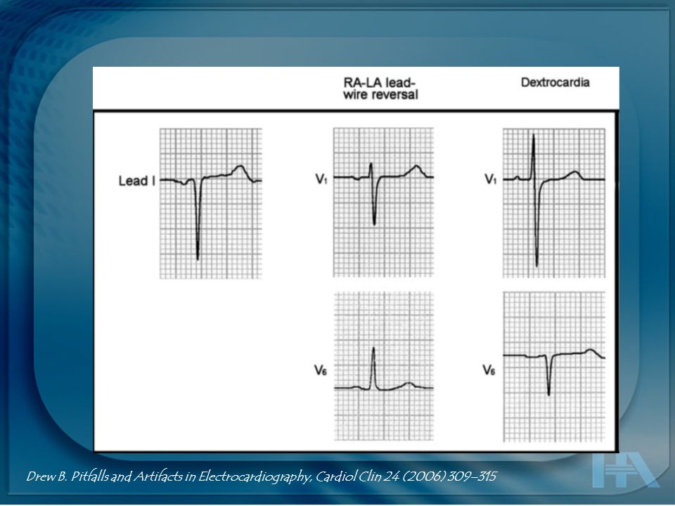Drew B. Pitfalls and Artifacts in Electrocardiography, Cardiol Clin 24 (2006) 309–315