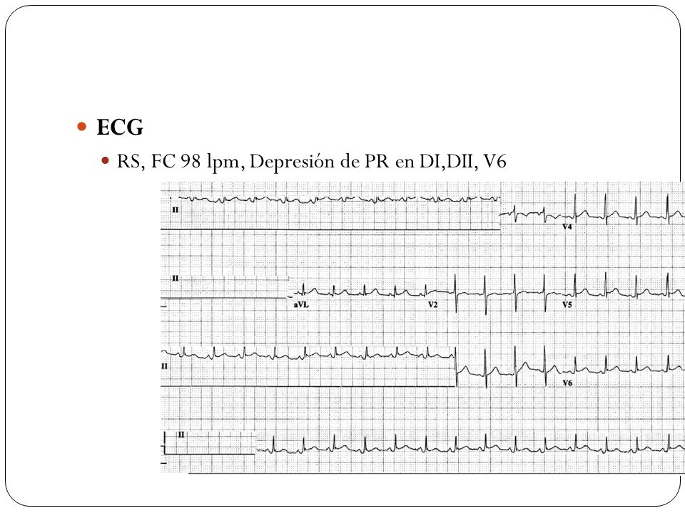 ECG RS, FC 98 lpm, Depresión de PR en DI,DII, V6