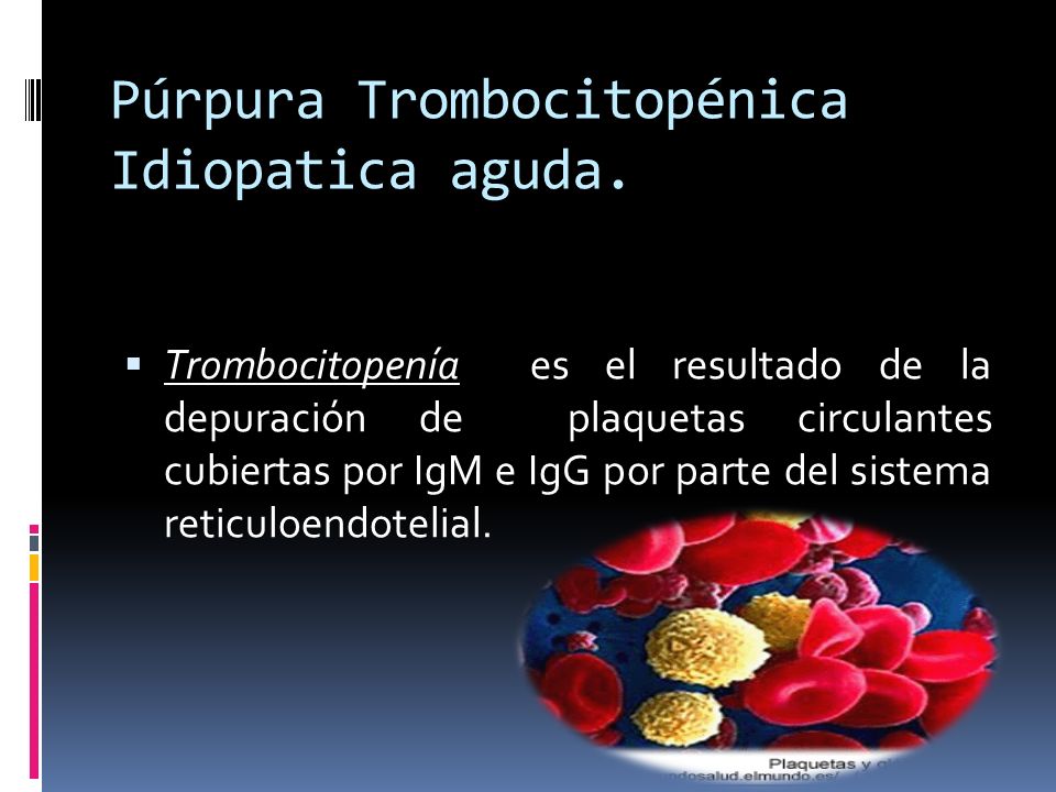 Púrpura Trombocitopénica Idiopatica aguda.