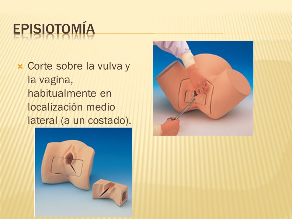 Episiotomía Corte sobre la vulva y la vagina, habitualmente en localización medio lateral (a un costado).
