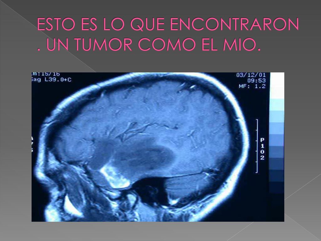 ESTO ES LO QUE ENCONTRARON . UN TUMOR COMO EL MIO.