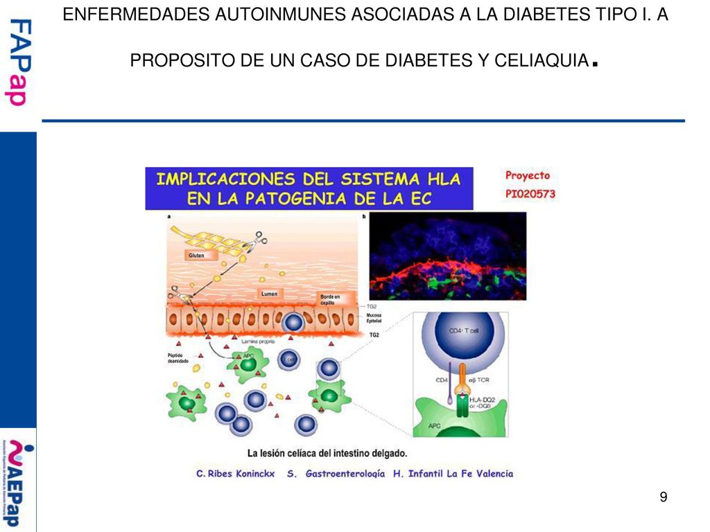 ENFERMEDADES AUTOINMUNES ASOCIADAS A LA DIABETES TIPO I