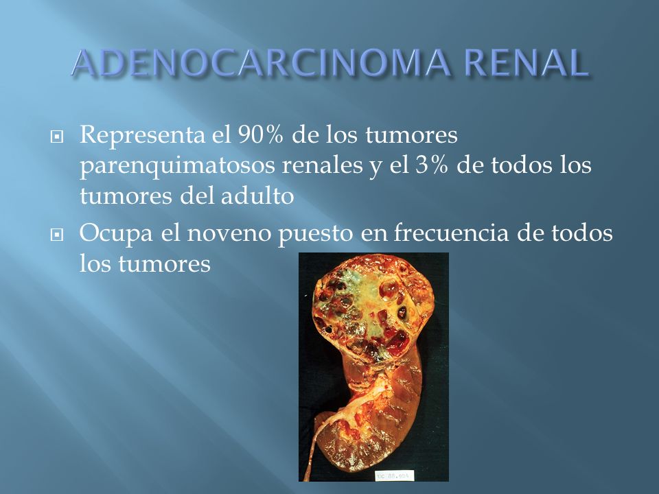 ADENOCARCINOMA RENAL Representa el 90% de los tumores parenquimatosos renales y el 3% de todos los tumores del adulto.