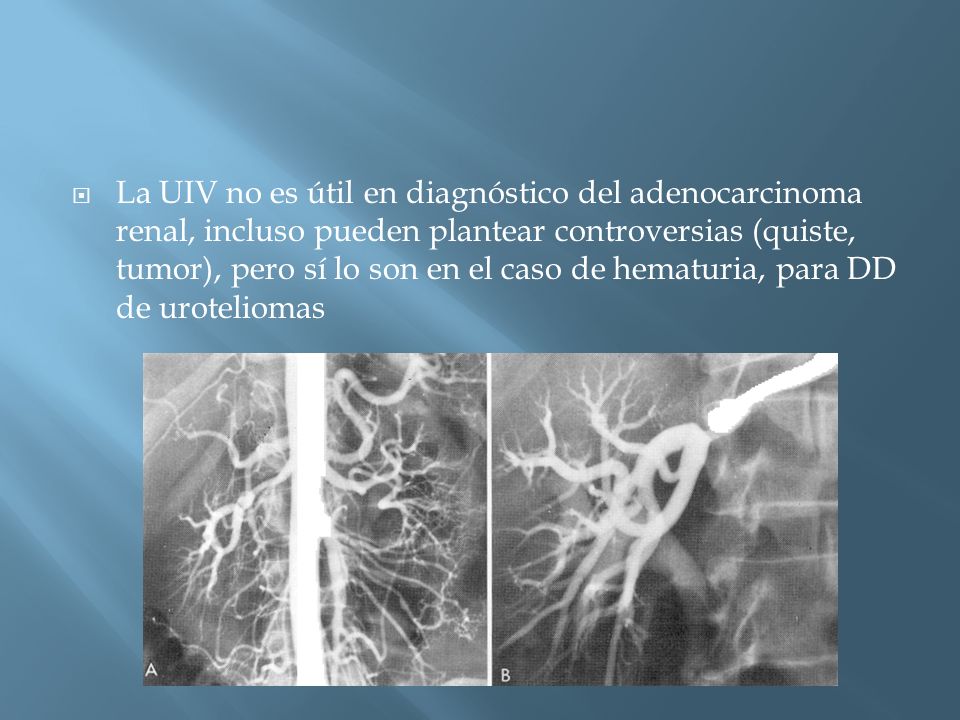 La UIV no es útil en diagnóstico del adenocarcinoma renal, incluso pueden plantear controversias (quiste, tumor), pero sí lo son en el caso de hematuria, para DD de uroteliomas