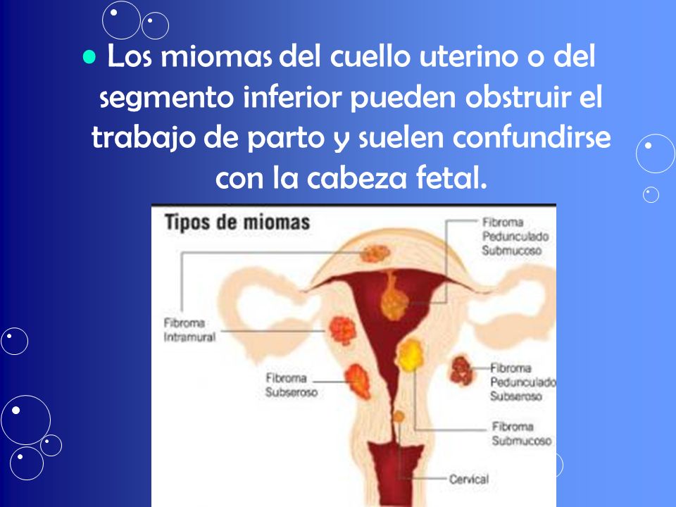 Los miomas del cuello uterino o del segmento inferior pueden obstruir el trabajo de parto y suelen confundirse con la cabeza fetal.