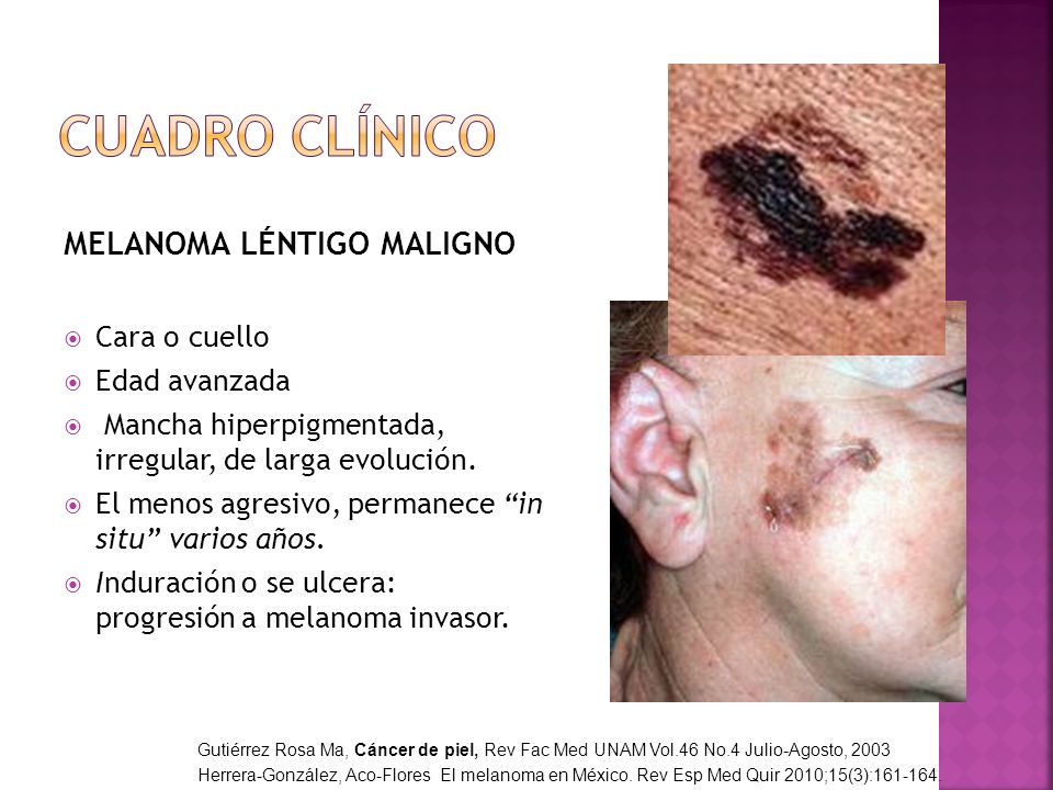 Cuadro clínico MELANOMA LÉNTIGO MALIGNO Cara o cuello Edad avanzada