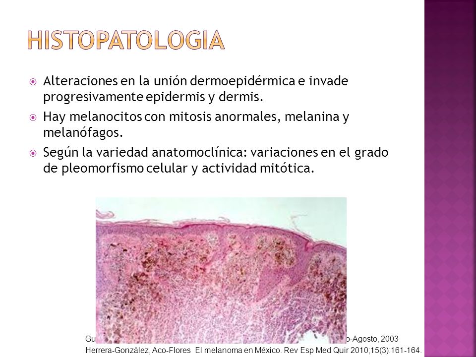 histopatologia Alteraciones en la unión dermoepidérmica e invade progresivamente epidermis y dermis.