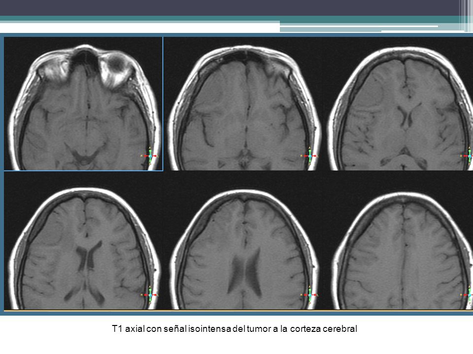 T1 axial con señal isointensa del tumor a la corteza cerebral