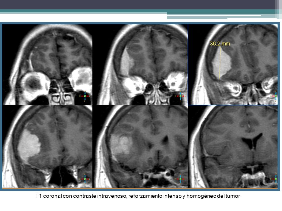 T1 coronal con contraste intravenoso, reforzamiento intenso y homogéneo del tumor