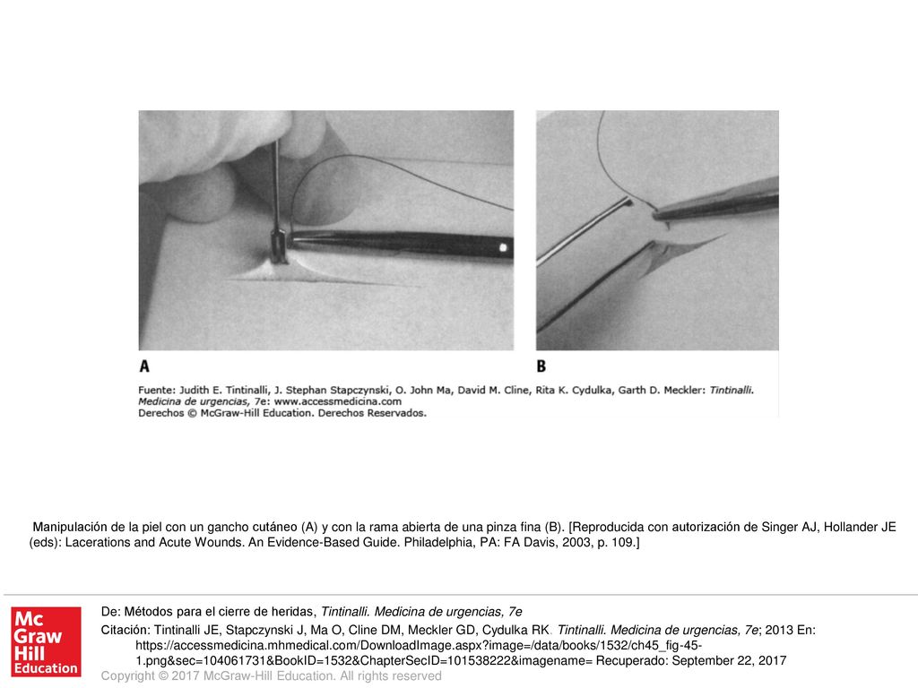 Manipulación de la piel con un gancho cutáneo (A) y con la rama abierta de una pinza fina (B). [Reproducida con autorización de Singer AJ, Hollander JE (eds): Lacerations and Acute Wounds. An Evidence-Based Guide. Philadelphia, PA: FA Davis, 2003, p. 109.]