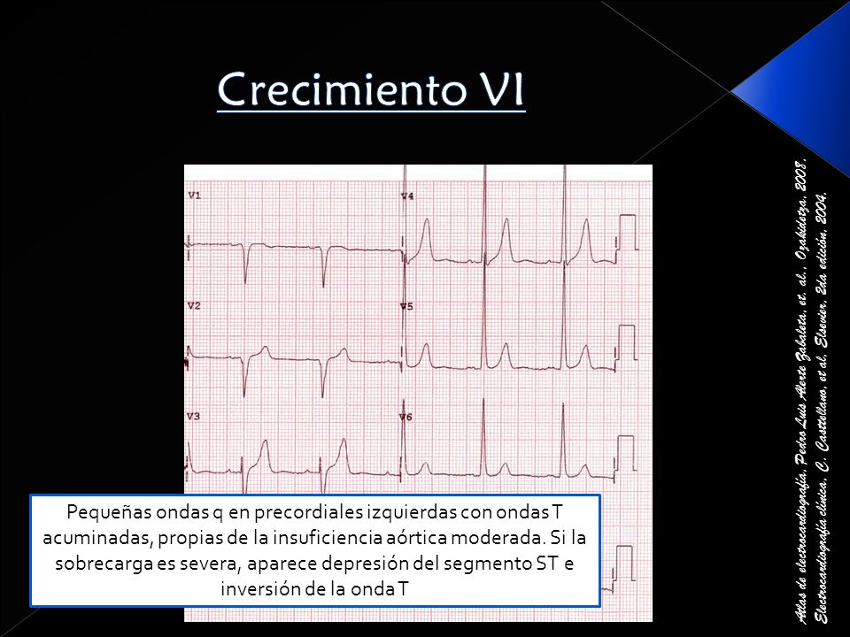 Crecimiento VI Atlas de electrocardiografía, Pedro Luis Alerte Zabaleta, et. al., Ozakidetza,