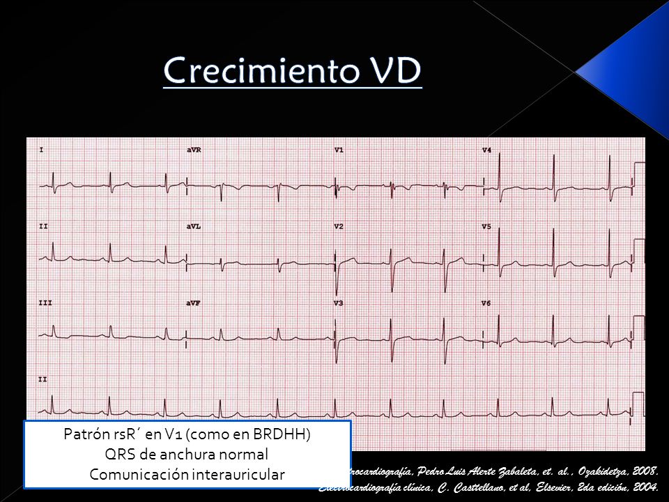 Crecimiento VD Patrón rsR´ en V1 (como en BRDHH) QRS de anchura normal