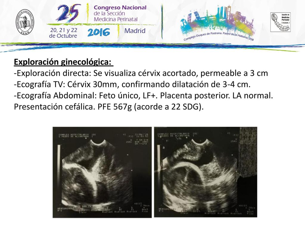 Exploración ginecológica: -Exploración directa: Se visualiza cérvix acortado, permeable a 3 cm -Ecografía TV: Cérvix 30mm, confirmando dilatación de 3-4 cm.