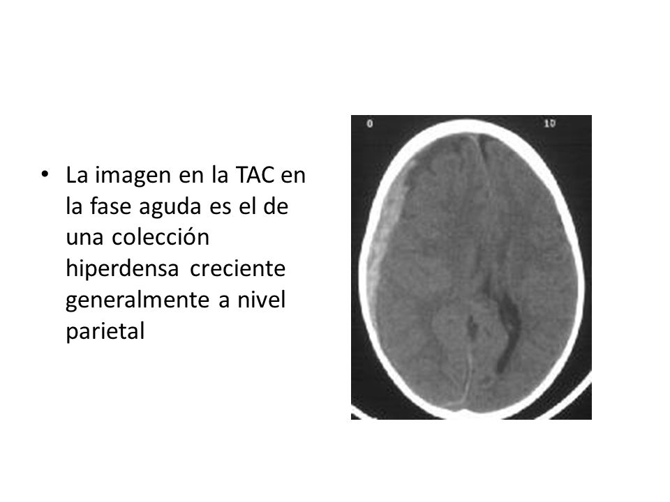 La imagen en la TAC en la fase aguda es el de una colección hiperdensa creciente generalmente a nivel parietal