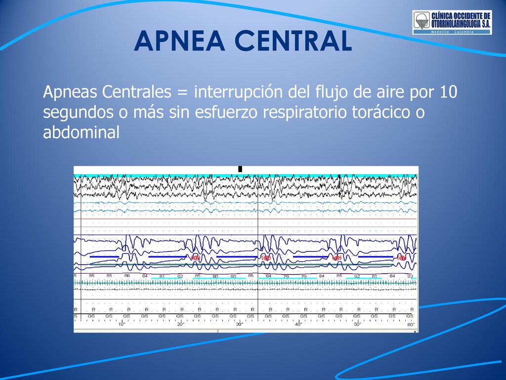 APNEA CENTRAL Apneas Centrales = interrupción del flujo de aire por 10 segundos o más sin esfuerzo respiratorio torácico o abdominal.