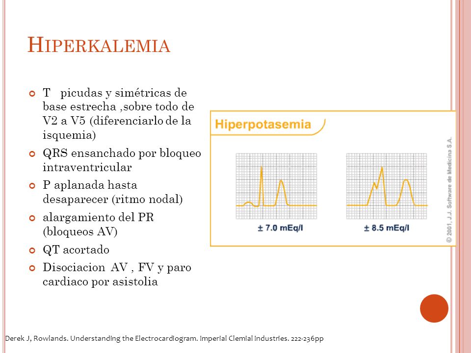 Hiperkalemia T picudas y simétricas de base estrecha ,sobre todo de V2 a V5 (diferenciarlo de la isquemia)