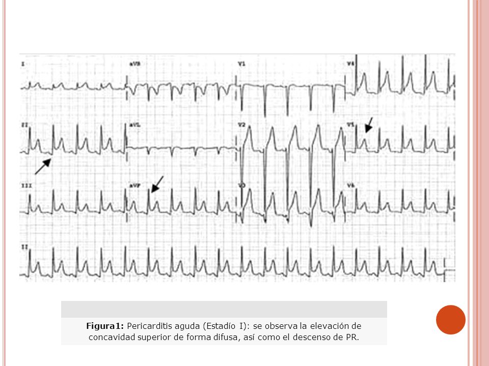 Figura1: Pericarditis aguda (Estadío I): se observa la elevación de concavidad superior de forma difusa, así como el descenso de PR.