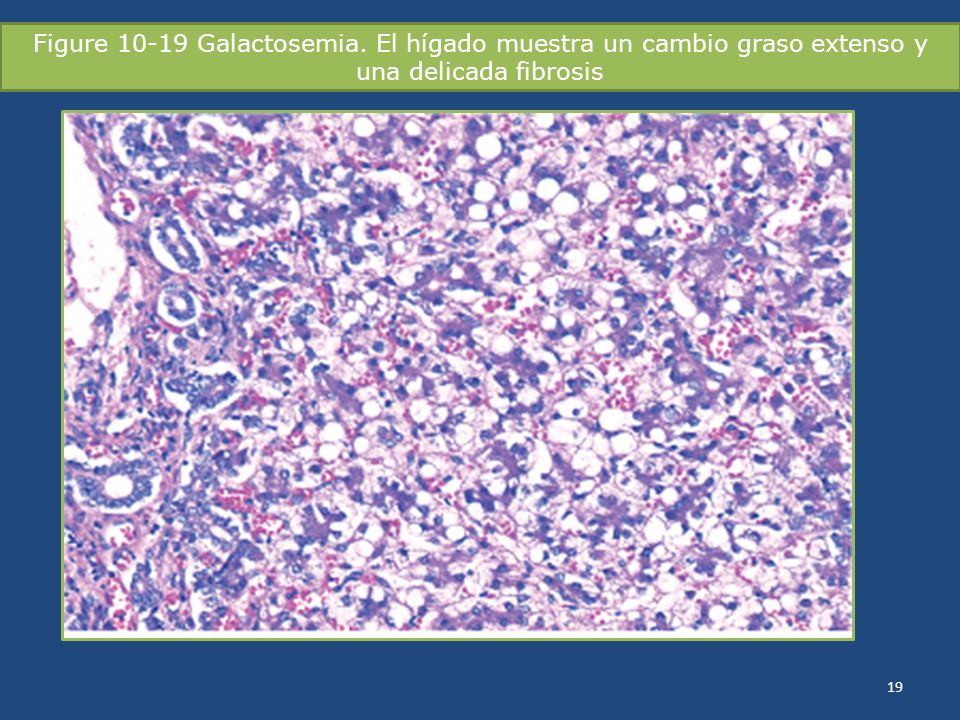 Figure Galactosemia. El hígado muestra un cambio graso extenso y una delicada fibrosis