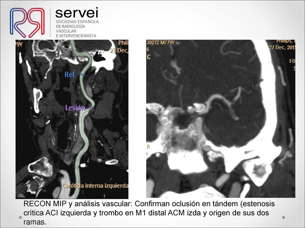 RECON MIP y análisis vascular: Confirman oclusión en tándem (estenosis crítica ACI izquierda y trombo en M1 distal ACM izda y origen de sus dos ramas.