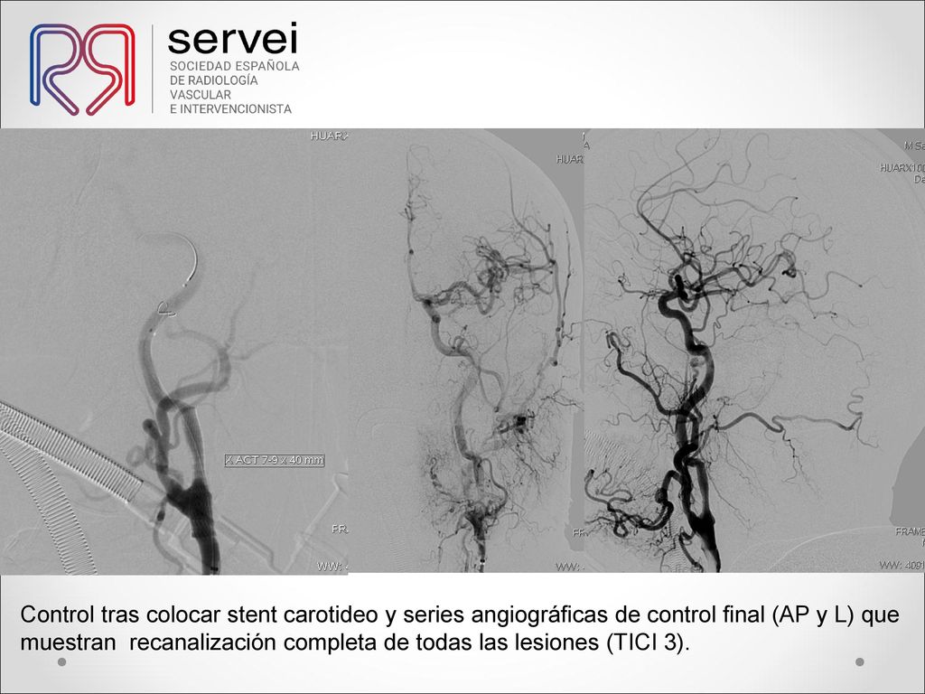 Control tras colocar stent carotideo y series angiográficas de control final (AP y L) que muestran recanalización completa de todas las lesiones (TICI 3).