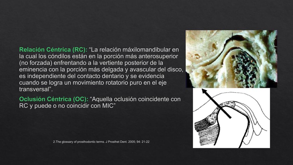 Relación Céntrica (RC): La relación máxilomandibular en la cual los cóndilos están en la porción más anterosuperior (no forzada) enfrentando a la vertiente posterior de la eminencia con la porción más delgada y avascular del disco, es independiente del contacto dentario y se evidencia cuando se logra un movimiento rotatorio puro en el eje transversal .