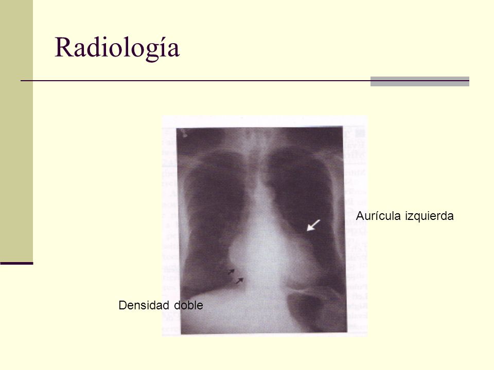 Radiología Aurícula izquierda Densidad doble